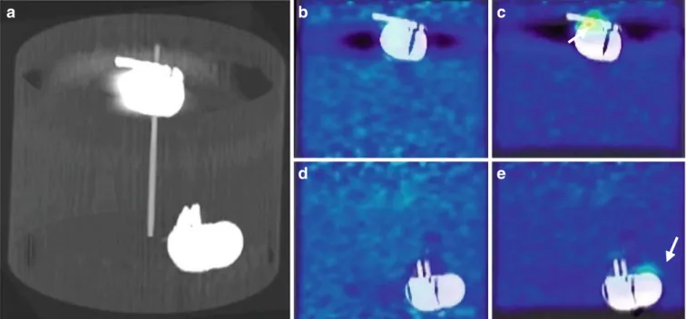 Figure 9 shows the impact of misalignment on the severity of artifactual uptake around pacemaker 1 in the heart/thorax phantom