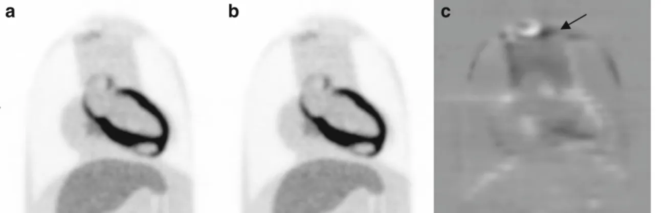 Fig. 9. Effect of misalignment in the RSD heart/thorax phantom. a PET image corrected for attenuation using aligned CT image and b using misaligned CT image by 10 mm