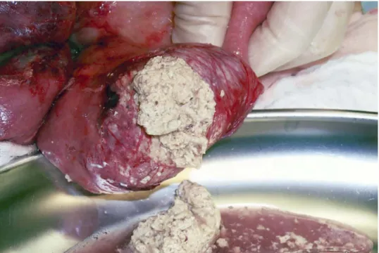 Fig. 2. Evacuation of the intraluminal plug through a jejunotomy.