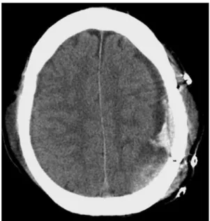Fig. 2 CT scan showing recurrent subdural hematoma before third surgery
