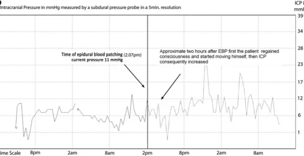 Fig. 3 a ICP measurement immediately before, during and after EBP procedure plus a 1 h period after EBP in 2-min intervals (the black solid line is representing the epidural blood patch procedure)