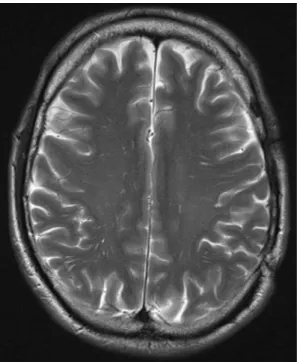 Fig. 4 MRI T2 scan showing the subsequent result 5 days after EBP