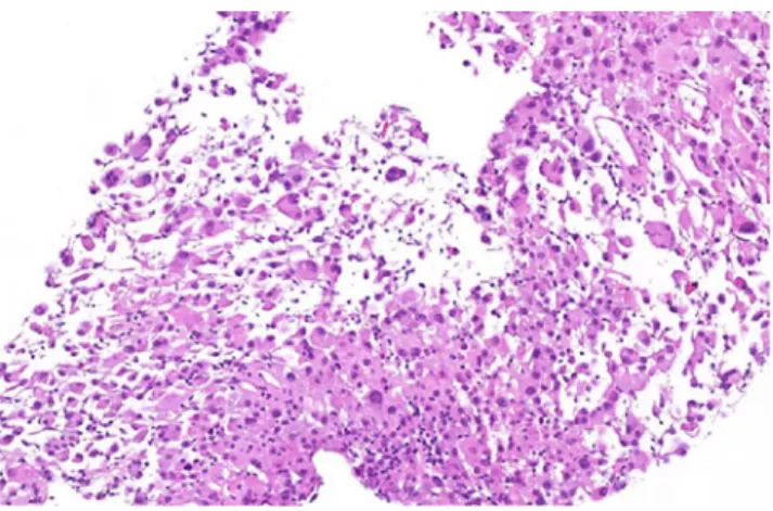 Table 5 Renal tumors with possibly focal or extensive papillary architecture