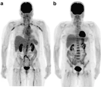 Fig. 2 18 F-FDG PET scans of two patients with giant cell arteritis. The scan in a 68-year-old woman without immunosuppressive drugs (a) shows pathologically elevated 18 F-FDG uptake in the aorta and its major branches