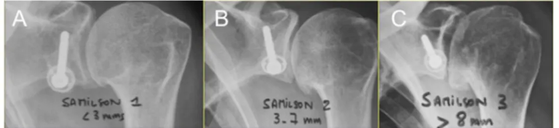 Fig. 2 Samilson 1 (a), 2 (b) and 3 (c) dislocation