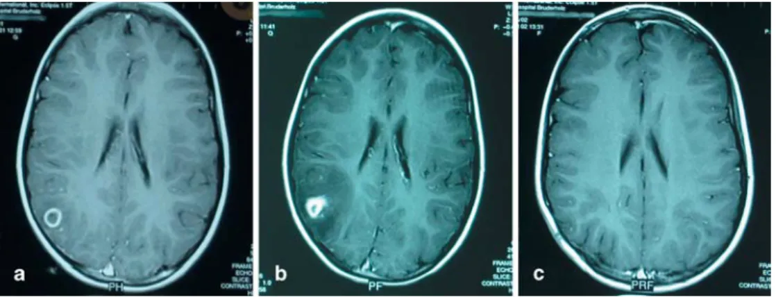 Fig. 2 Computer-assisted surgery (CAS) system (Aesculap AG, Tuttlingen, Germany). On the left side is the infrared camera  (Po-laris, Northern Digital, Ontario, Canada) and on the right the workstation (Dell) with coronal, sagittal, and axial CT scans, and