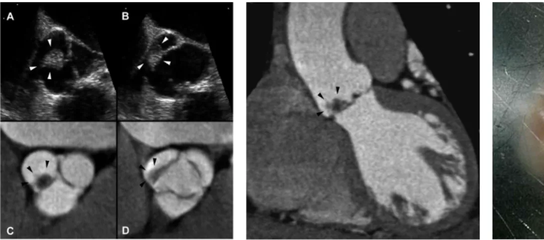 Figure 3. Macroscopic specimen shows the ap- ap-pearance of the tumor immersed in saline  solu-tion resembling a sea anemone which is  consid-ered diagnostic of papillary fibroelastoma.