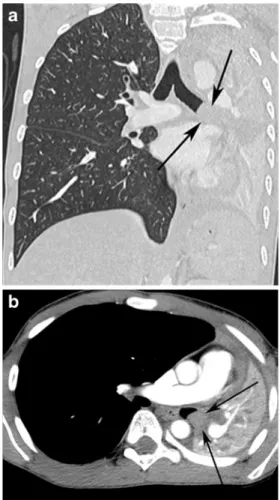Fig. 4 Fused coronal PET/CT image demonstrates intense 18F-FDG uptake in the pulmonary mass ( arrow )