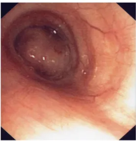 Fig. 5 Endoscopic view of the left main bronchus shows an obstruc- obstruc-tive endobronchial mass