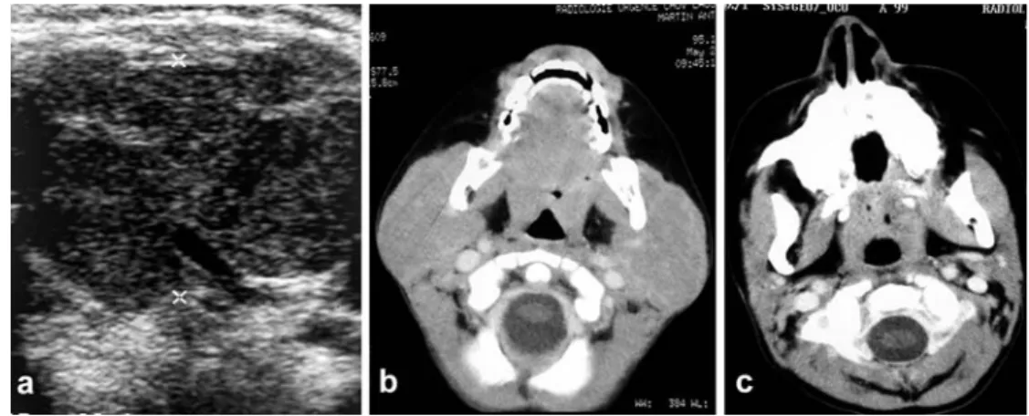 Fig. 3 a Cervical US of a 3-year-old boy demonstrates bilateral symmetrical  enlarge-ment of the parotid glands, conﬁrmed by CT (b) and owing to diﬀuse histiocytic inﬁltration.
