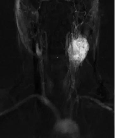 Fig. 1 Coronal magnetic resonance projection angiography image of a large left-sided glomus caroticum tumor in early arterial phase (matrix size 256 ¥ 256, data acquisition of four images per second)