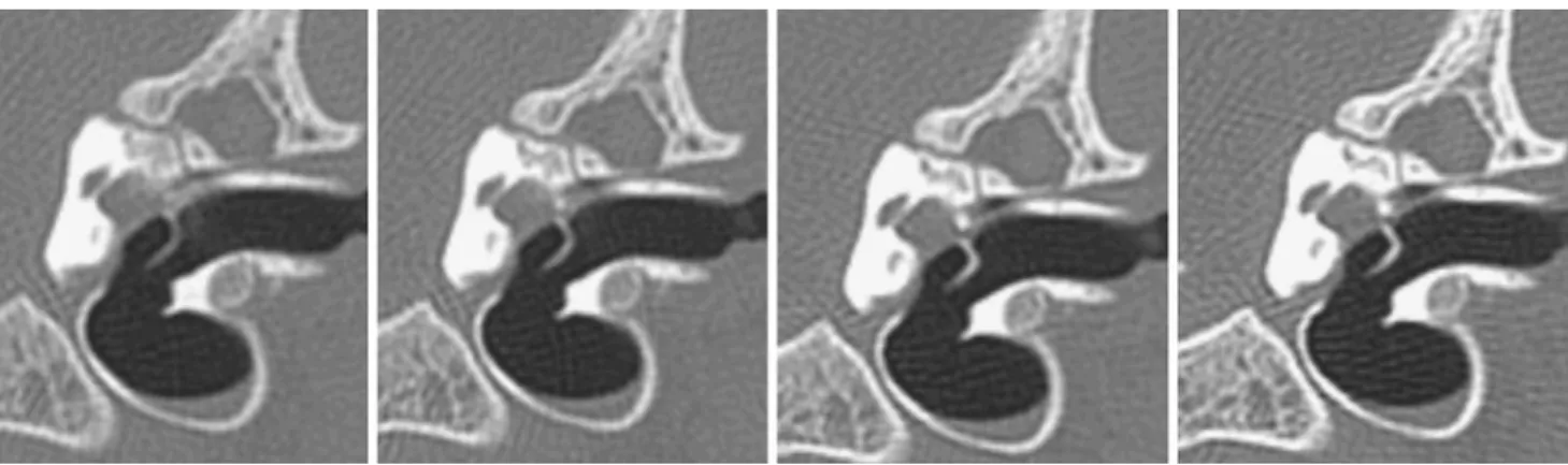 Fig. 8 Scans of a lamb temporal bone performed with 7 mGy, a dose corresponding to a clinical low-dose protocol