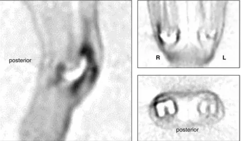 Fig. 2 Sagittal, coronal and axial view of a FDG PET-scan of a patient with both sided knee implants; high FDG  up-take at the antero-lateral aspect of the right knee, where  intra-operatively a fat-pad  impinge-ment was confirmed