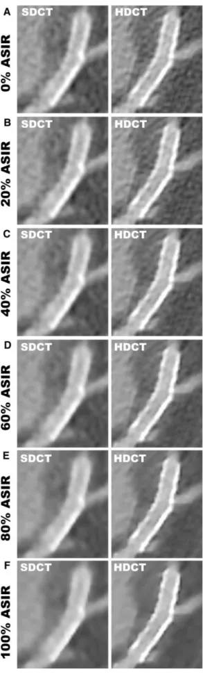 Fig. 5 Curved multiplanar reconstruction of a stent scanned with 64-slice SDCT (left column) and HDCT (right column) reconstructed by 0 % ASIR (a), 20 % ASIR (b), 40 % ASIR (c), 60 % ASIR (d), 80 % ASIR (e) and 100 % ASIR (f)
