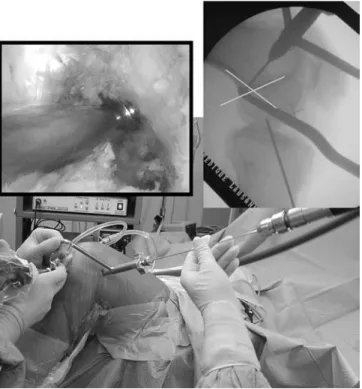 Fig. 2 Femoral guide wire is drilled from a lateral incision. Left arthroscopic control, right lateral ﬂuoroscopic control showing the optimal placement of the guide wire
