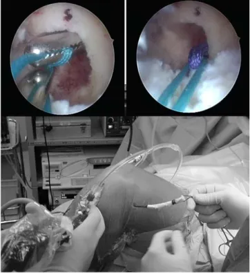 Fig. 3 Drilling of femoral tunnel from lateral incision. Left arthroscopic view of a curette above the tip of pin, right position of tunnel at footprint at the 9:30 position