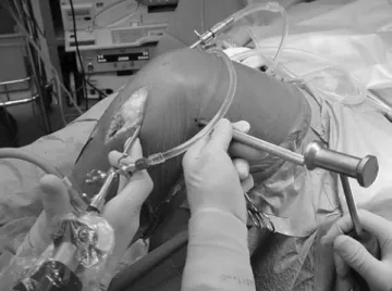 Fig. 5 The assistant hammering light using an impactor on the tibial bone plug while the surgeon performs traction distally on the sutures