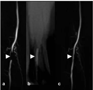 Fig. 3 Intra-arterial MR angiography in a patient with peripheral artery occlusive disease (PAOD) before (a), during (b) and after (c) dilatation of the femoro-popliteal artery