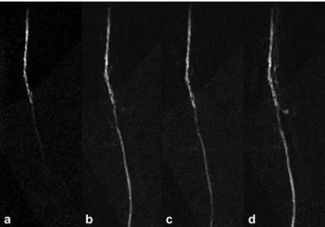 Fig. 4 Complex subtracted intra-arterial near real-time contrast-enhanced MRI of the superficial femoral artery in a patient with peripheral artery occlusive disease