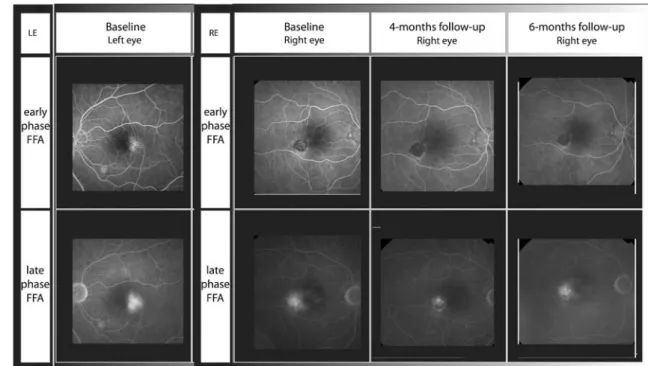 Fig. 2 OCT findings (macular map and horizontal macular scan) of the right eye at the baseline, at 4-month follow-up and at 6-month follow-up.