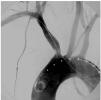 Fig. 4 Selective angiography confirming the rupture and rotation of the caudal stent extremity