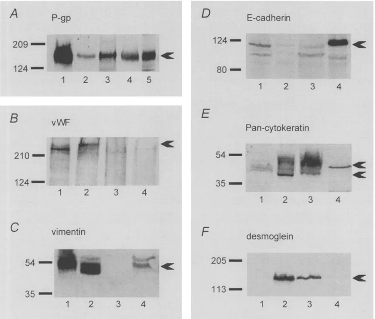 FiG. 4.  Expression  of  P-gp,  vW1 ~, vimentin,  E-cadherin,  Pan-c.ytokeratin,  and  desmoglein