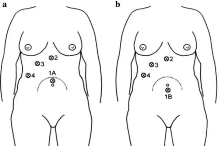 Fig. 1 Position of the trocars for a cholecystectomy and b appendectomy