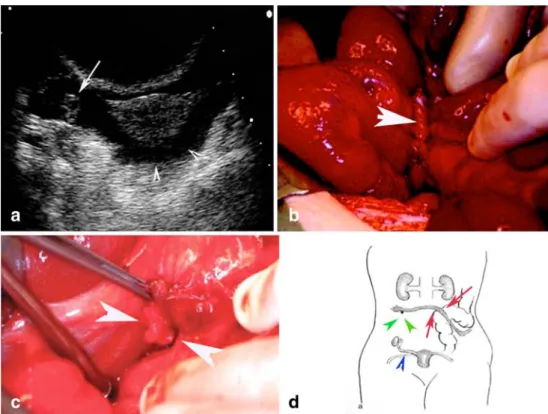 Fig. 10 A 2-year-old girl pre- pre-sented with an asymptomatic palpable movable mass in the left groin