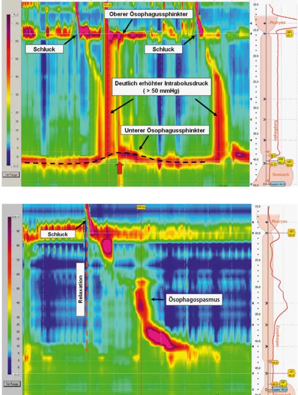 Abb. 4  7  Fokaler Spas-  Fokaler Spas- mus im mittleren Ösopha-gus bei einem Patienten   mit Dysphagie und nicht-kardialem Thoraxschmerz.  Die Koordination zwischen  dem proximalen und dem  distalen Kompartiment   der Speiseröhre ist unter- brochen. Die D