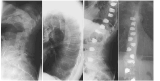 Fig. 4 X-rays of the spine of a 68-year-old woman under steroid medication for years due to a heart transplantation