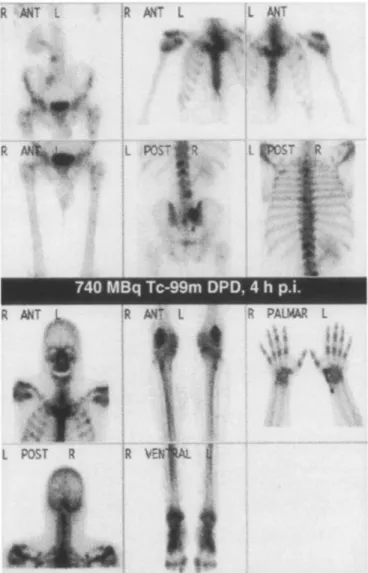 Fig. 2.  Skeletal  scintigraphy of patient 3 at the  time of admission. 