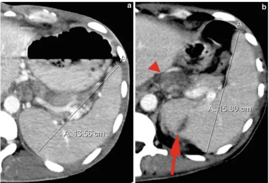 Figure 1. (a) Contrast-enhanced transverse CT of the abdomen showing the size of the spleen (13.6 cm) on admission.