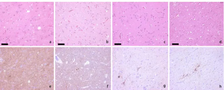 Fig. 4   Histopathological findings in frontal cortex of sCJD patients. HE stain (A–D) and PrP immunostain (E–H) shows spongiform changes and CJD-type specific PrP  deposits