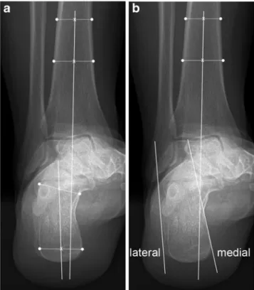 Fig. 1 Measurement of hindfoot alignment on hindfoot alignment radiographs. The axis of the distal tibial shaft served as a reference for all measurements