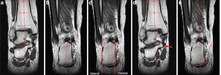 Fig. 2 MR measurement techniques: Angle between the distal tibial shaft (a) and the calcaneal axis (adapted Cobey), which was defined by four points on the calcaneal surface