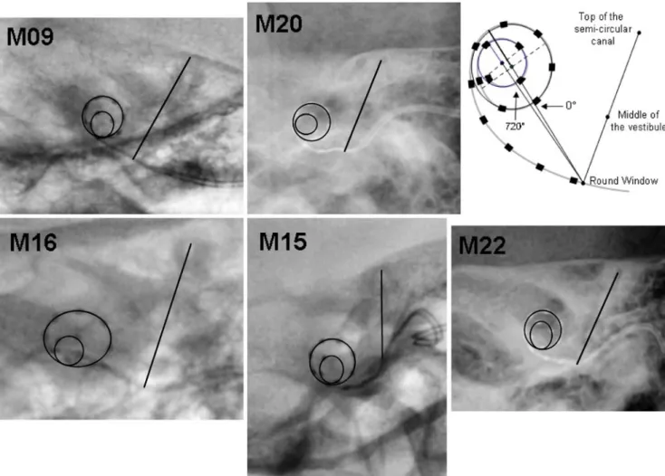 FIG. 3. Radiographs obtained for each subject after the modified Stenver_s view. The line going through the top of the superior semicircular canal and the center of the vestibule crosses the electrode array at the estimated site of the round window