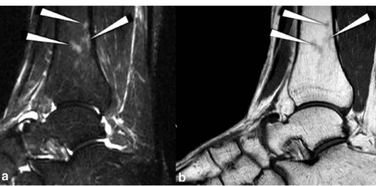 Fig. 2 A 31-year-old asymp- asymp-tomatic female volunteer with multiple edema-like Type 1 bone marrow changes
