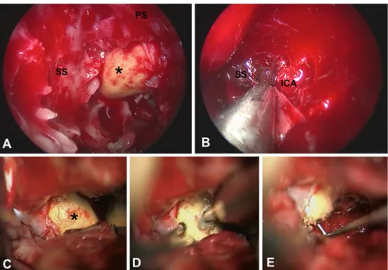 Fig. 2 a – b Transnasal intraoperative endoscopic view: