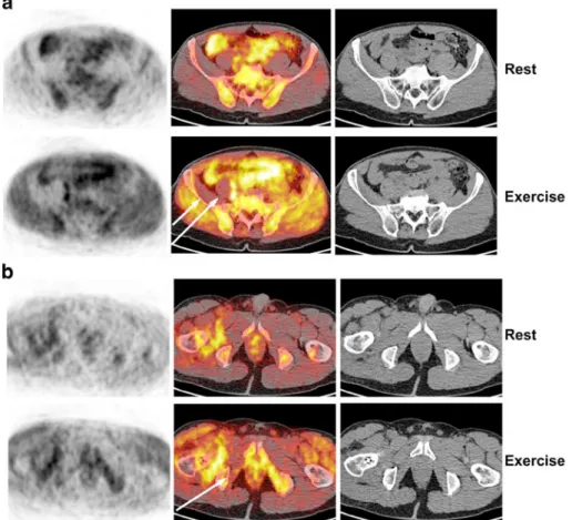 Fig. 1. [ 11 C]acetate PET/CT 3 weeks after right hip arthroplasty through the posterior “ Kocher Langerhans ” approach