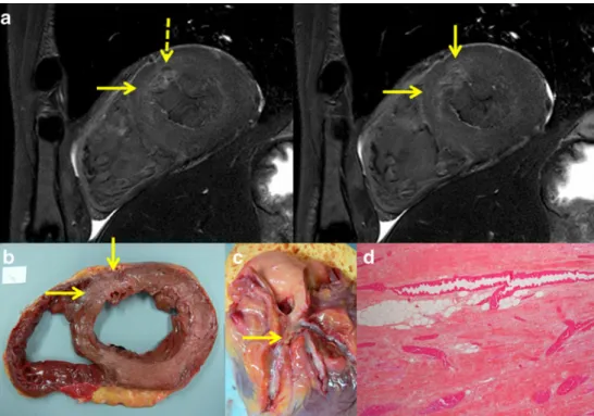 Fig. 2 Subacute myocardial infarction (case 13) in pmMRI. a T2-weighted short axis images at different levels show a broad hyperintensity (arrows) affecting the anteroseptal wall