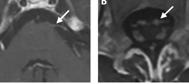 Fig. Gadolinium-enhanced T1-weighted MRI showing massive meningeal contrast enhancement (flashes) along cranial (A) and lumbar spinal (B) nerve roots736_737_Hermann_JON_1744  02.06.2005  12:28 Uhr  Seite 737