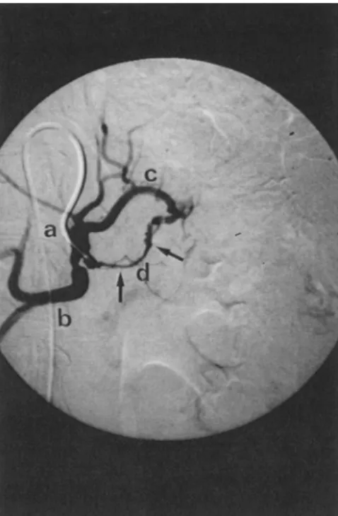 Fig.  1.  Celiacography  in  a  patient  suffering  from  adenocarcinoma  of  the  pancreatic  body:  the  tip  of  the  transfemorally placed arterial catheter is positioned in the  celiac  axis