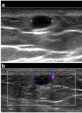 Fig. 1 Longitudinal a B-mode and b color Doppler US images (17 – 5 MHz linear probe) of the lateral aspect of the right armFabio Becce and Emilie Uldry contributed equally to this work.