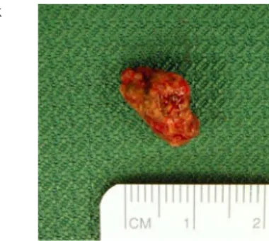 Fig. 1 At surgery a 14 x 11 x 8 mm stone was founded  adja-cent to the peroneus longus tendon