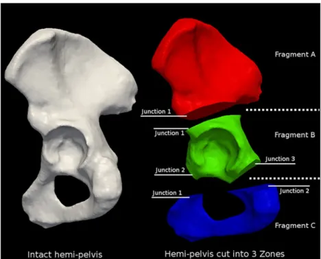 FIGURE 5. Cutting configuration of the hemi-pelvis into three fragments. Zone I, II, and III in (F A ) red, (F B ) green, and (F C ) blue according to the guidelines presented in Enneking et al