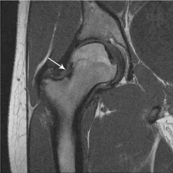 Fig. 9 Coronal T1-weighted (565/13) magnetic resonance image.