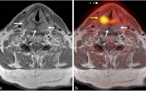 Fig. 5 PET/MRI with FDG obtained in a patient with suspected recurrence after chemoradiotherapy