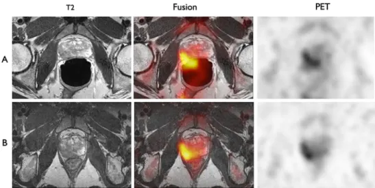 Fig. 9 Example of correct and low quality fusion of PET and MRI images due to different bladder filling