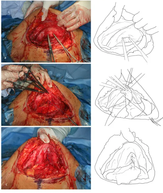 Fig. 1 a The abdominal wall is lifted upwards, and the fascia borders of the umbilical hernia defect are palpated and grasped with Kocher clamps
