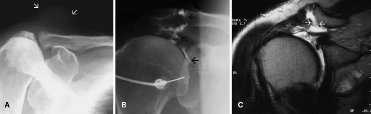 Table 1 Overview of patients with acromioclavicular (AC) joint cysts (Sub subscapularis, SS supraspinatus, IS infraspinatus, TM teres minor, Bi biceps brachii, CPPD calcium pyrophosphate phosphate dihydrate)